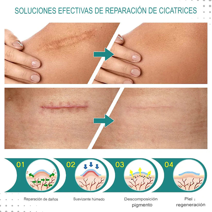 SiliconeScar - Cinta para la Eliminación de Cicatrices